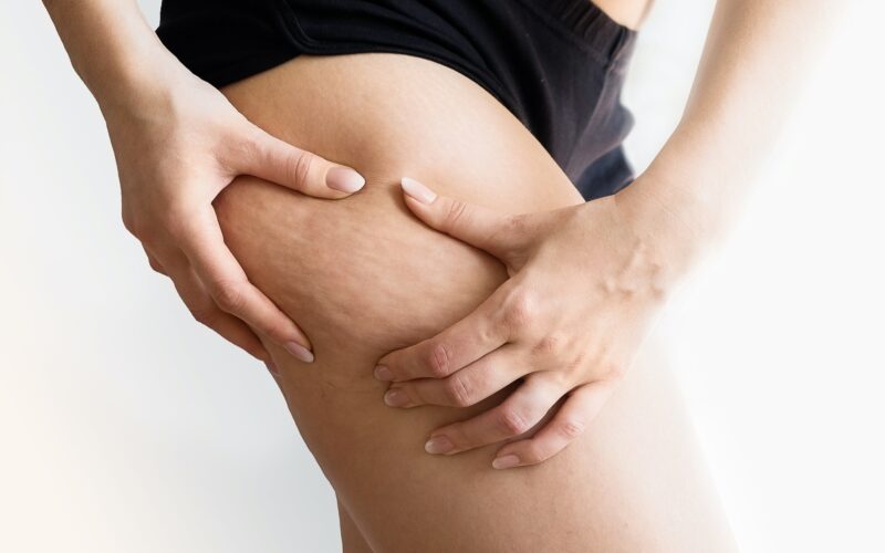 Girl shows holding and pushing the skin of the legs cellulite, orange peel. Treatment and disposal of excess weight, the deposition of subcutaneous fat tissue.